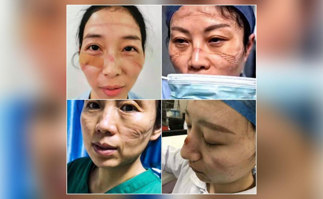 Nurses treating coronavirus patients left with marks on faces due to